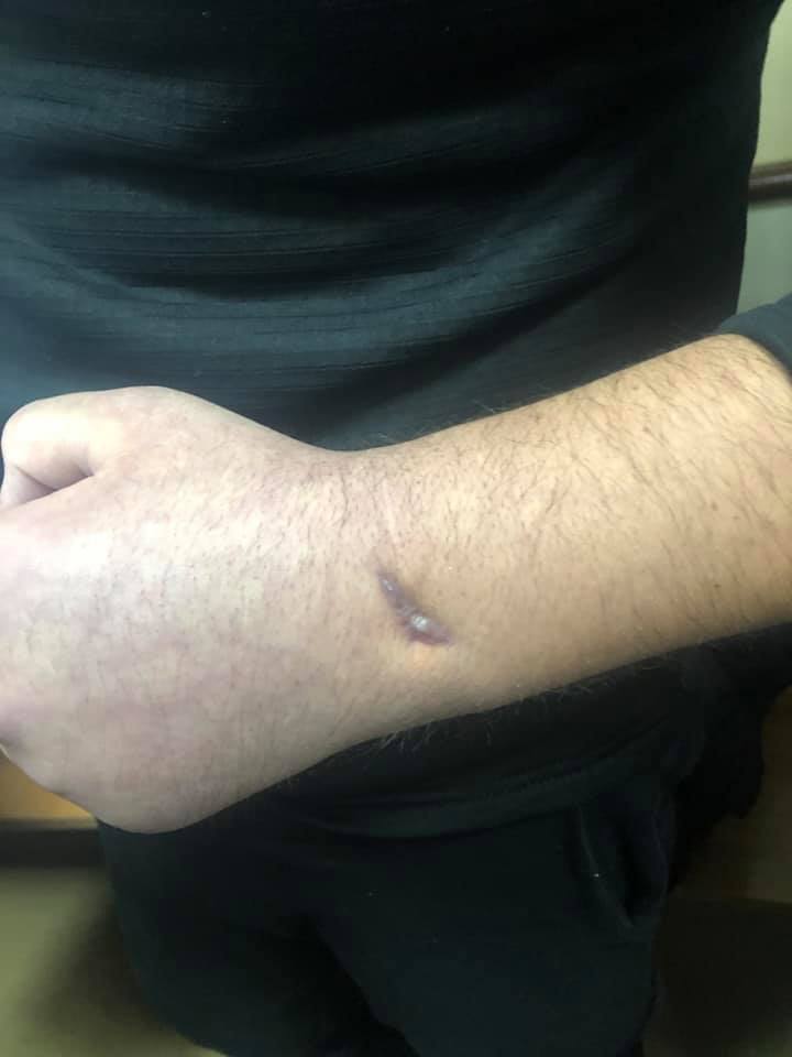 У полоненого моряка Василя Сороки після поранення пальці не згинаються, набряк не сходить